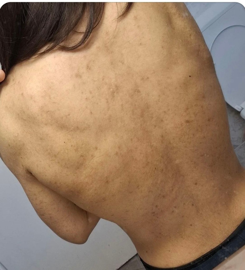 Back hyperpigmentation and follicular dark marks — From the Lab